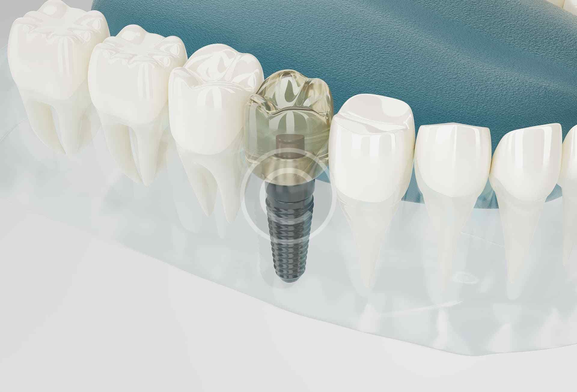 Implantes Dentales